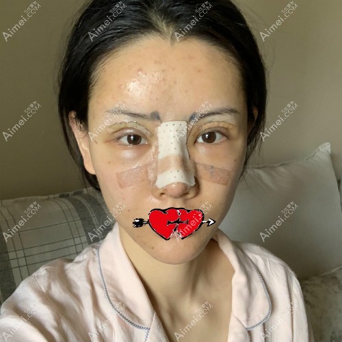 杭州整形医生张龙隆鼻案例：肋骨鼻术前素颜照片