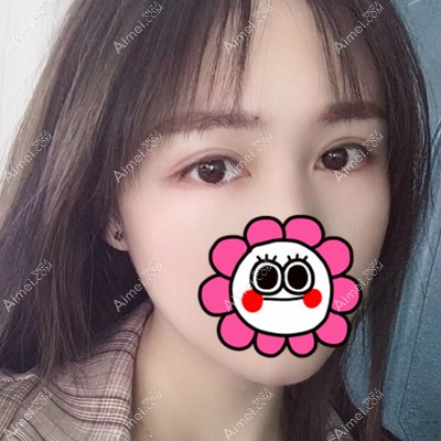 找襄阳华美赵晨雨院长做全切双眼皮术后1个月就没有肉条感