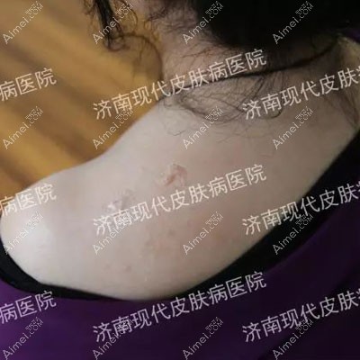 20年的疤痕疙瘩,没花多少钱在济南现代皮肤病医院治疗好了
