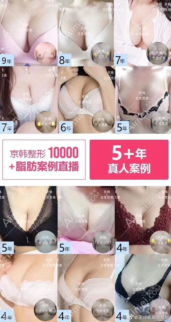 北京京韩的自体脂肪隆胸模特.jpg