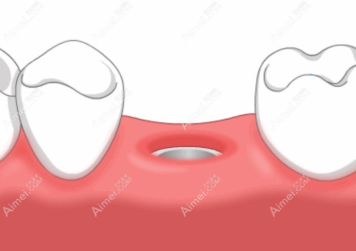 牙齿拔了3年还能种牙吗？牙齿宽度和牙槽骨萎缩情况来决定