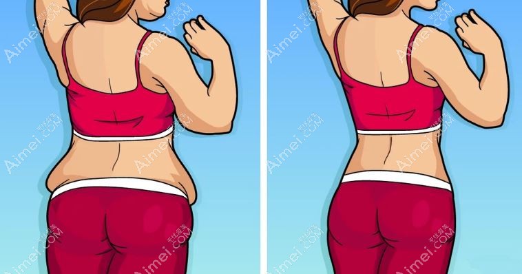 怎么减掉胯部两侧的赘肉?不想运动做腰腹吸脂手术也能改善