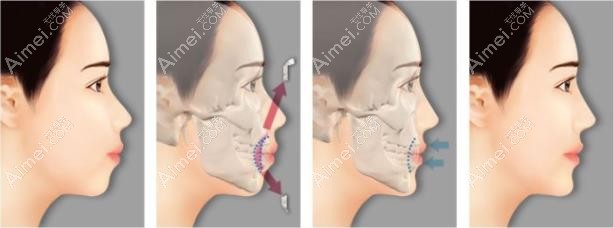 骨性凸嘴做正颌手术后脸型改变图