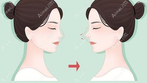 易普锋医生做过的鼻子实例分享:膨体/肋骨隆鼻做的好价格低